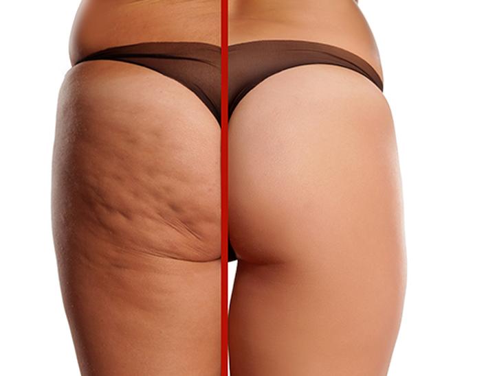 Dieta i styl życia a cellulit