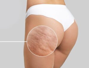 Odkryj Wszystko, Co Powinieneś Wiedzieć o Cellulicie – Kilka Ważnych Informacji