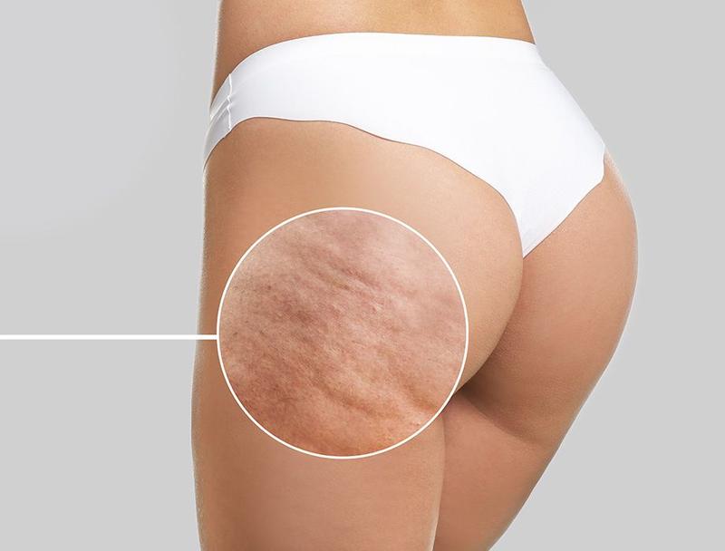 Odkryj Wszystko, Co Powinieneś Wiedzieć o Cellulicie – Kilka Ważnych Informacji