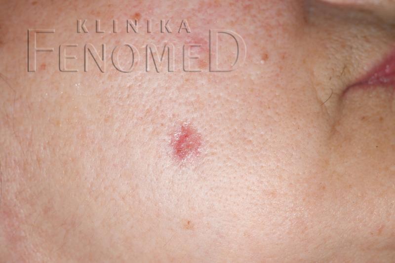 Czy to rak skóry? Nie bagatelizuj tych objawów!